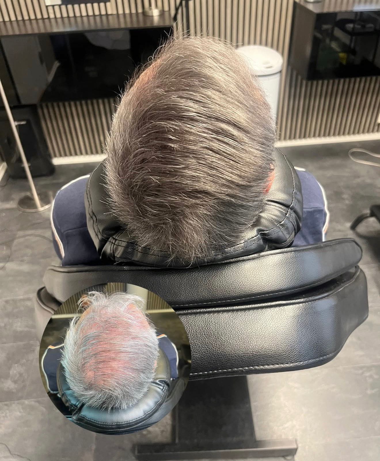 SMP efter hårtransplantation med grått hår