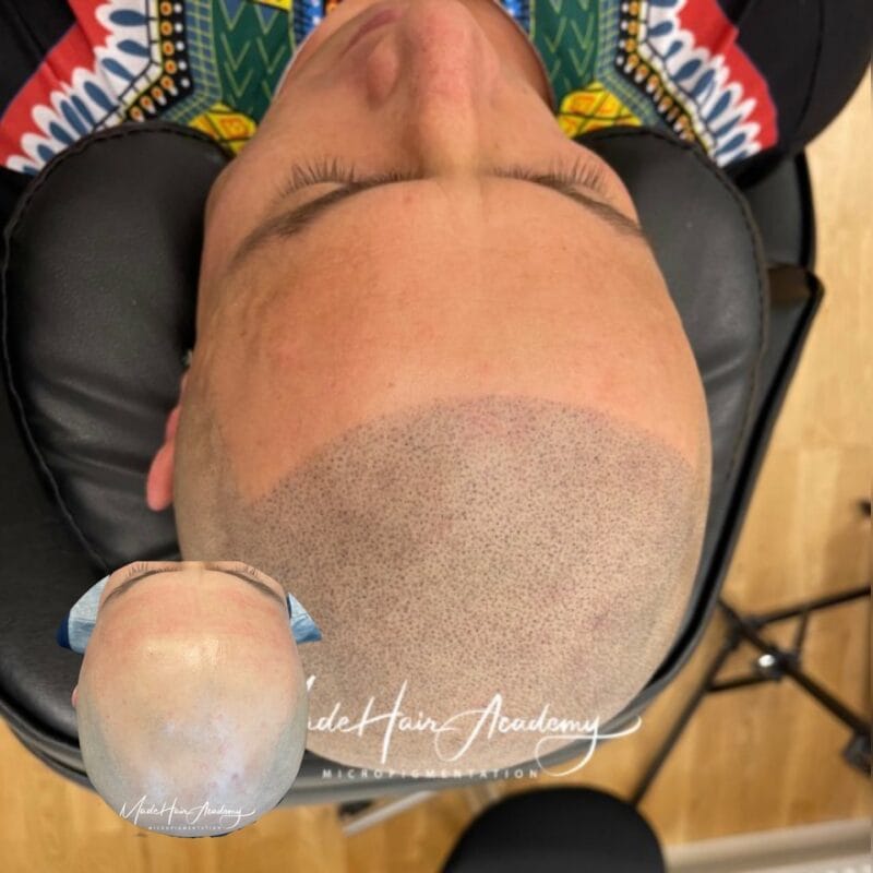 Scalp micropigmentation resultat hos Made Hair Academy