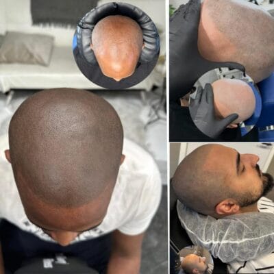 vad kostar scalp micropigmentation