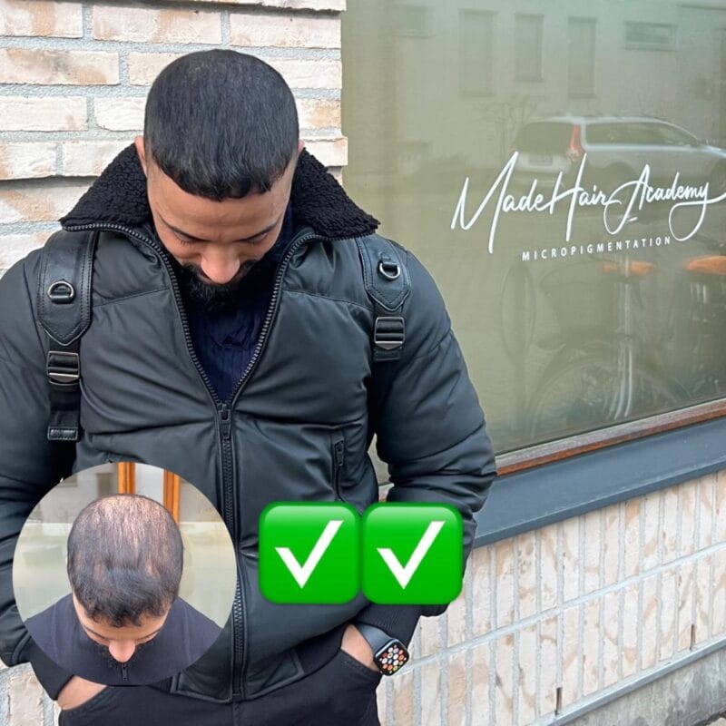 ikke fornøyd etter haartransplantasjon made hair academy goeteborg