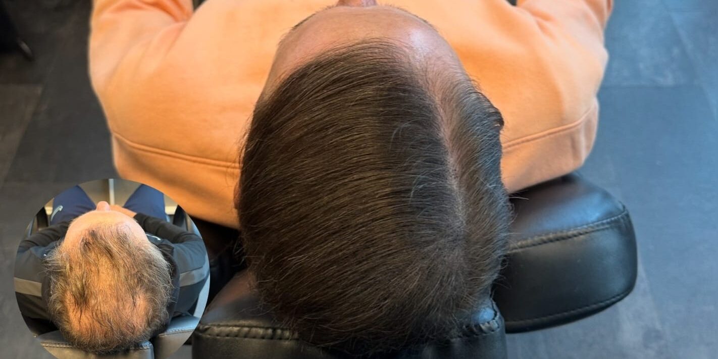 scalp-micropigmentation-hårfyllnad-med-Scalp-Mikropigmentering-man-40ar-Göteborg Manligt håravfall och hårutfyllnad med SMP
