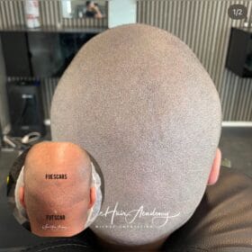 Naturlig resultat av SMP etter hårtransplantasjon hos Made Hair Academy i Göteborg