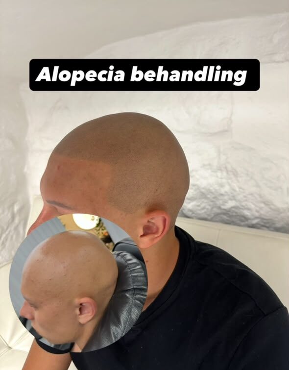 Alopecia universalis med SMP som kosmetisk scalp-behandling
