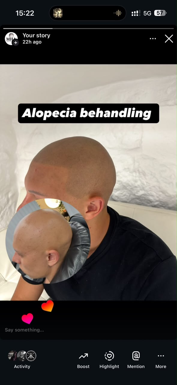 SMP behandling vid alopecia