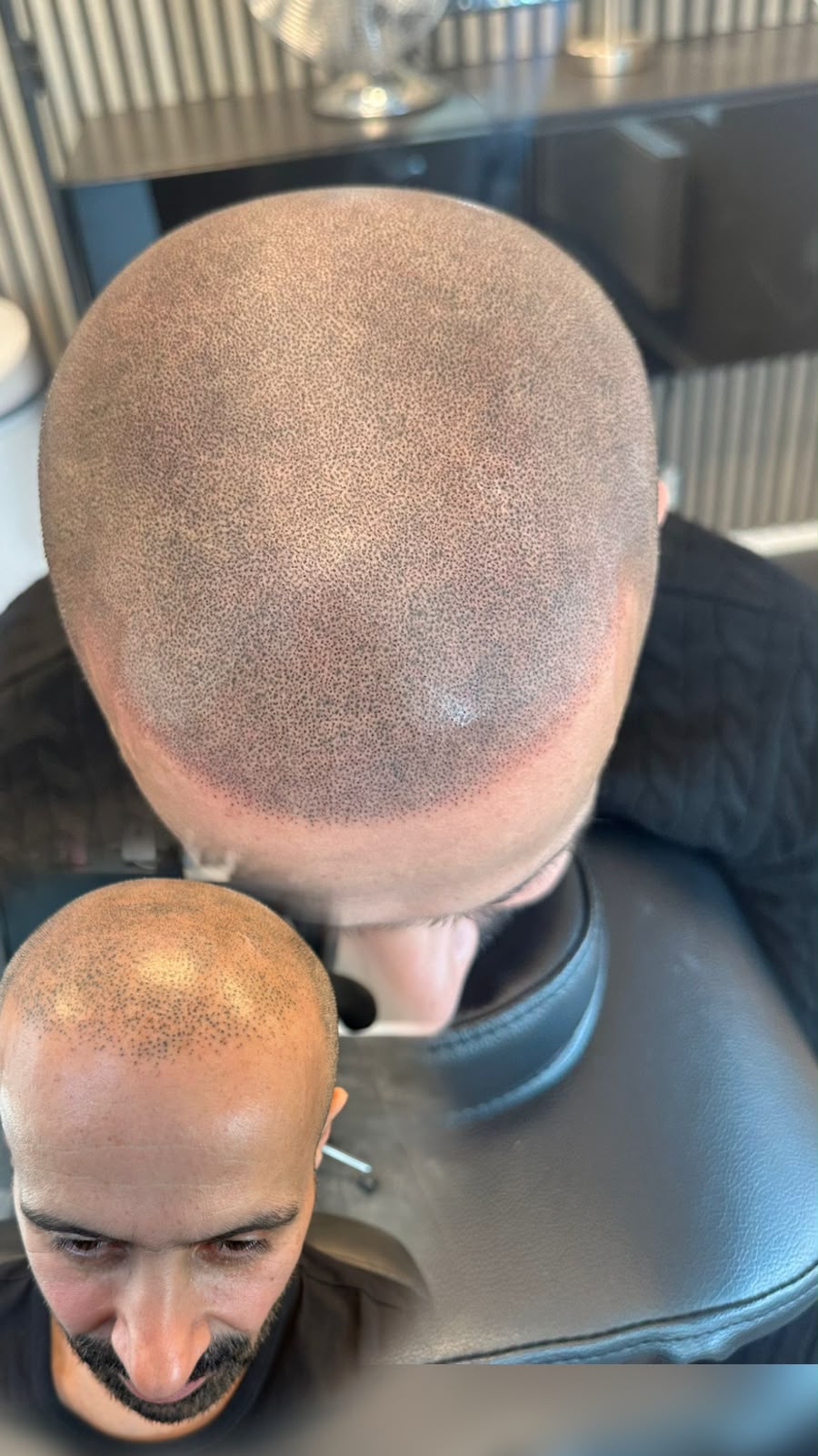 Före och efter SMP korrigering hos Made Hair Academy