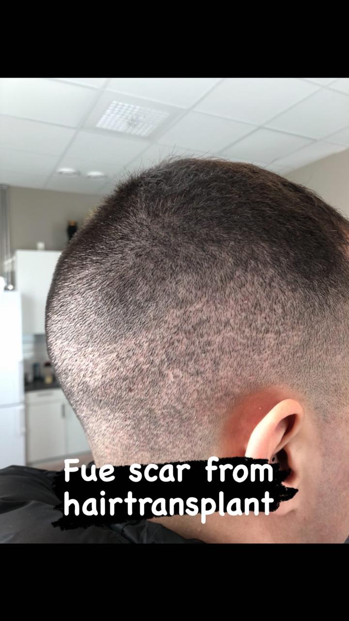 Närbild på FUE ärr och extraktionspunkter i donorområdet