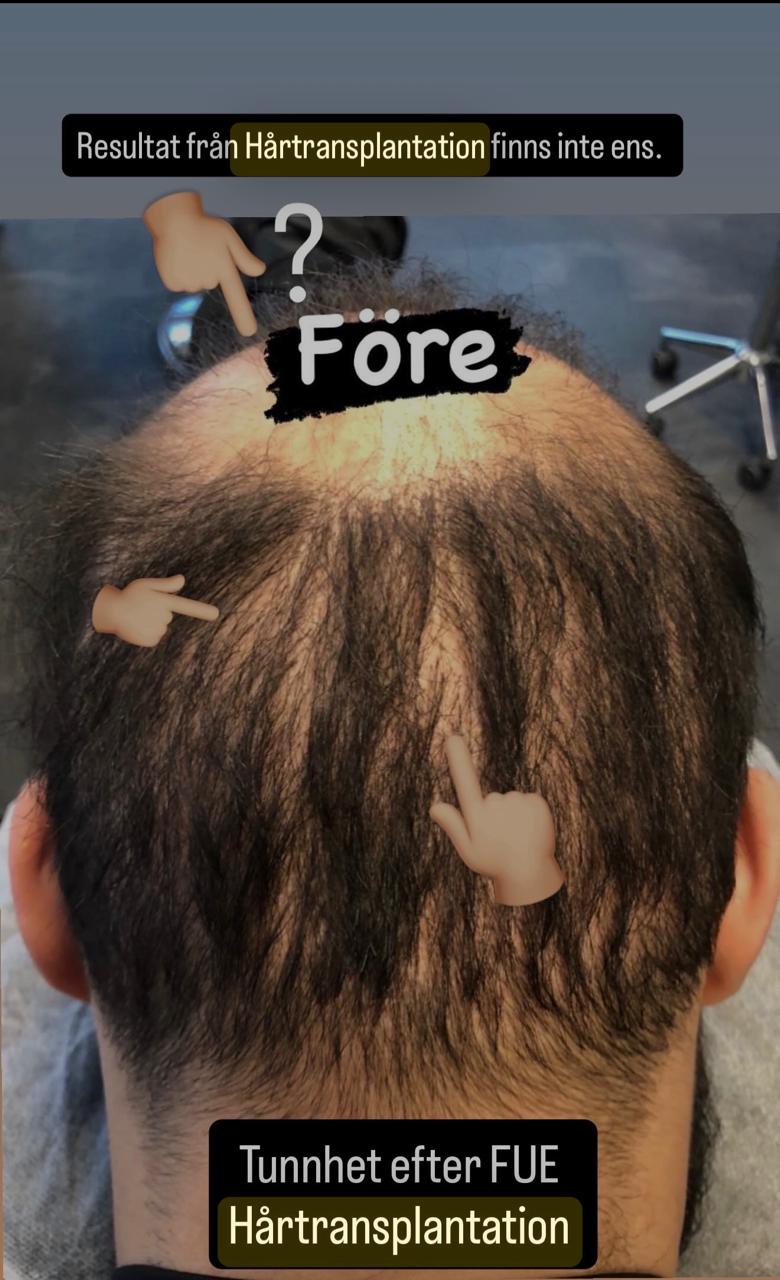 Synliga FUE ärr i nacken efter hårtransplantation