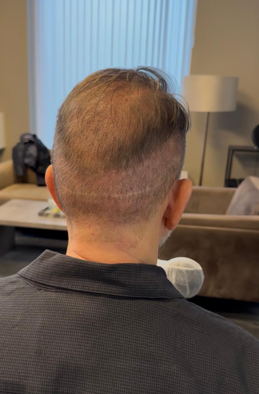 Donorområde med längre hår efter FUE hårtransplantation inför första SMP behandlingen