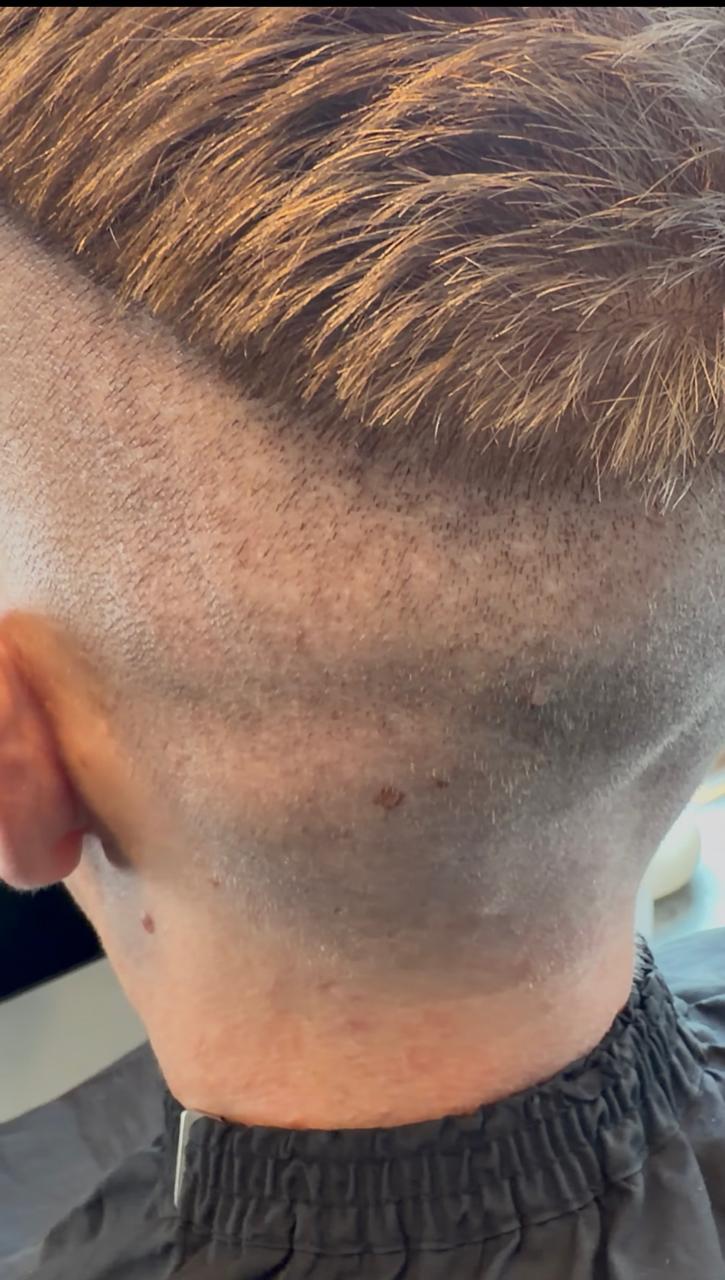 Glest donorområde efter tidigare FUE hårtransplantation