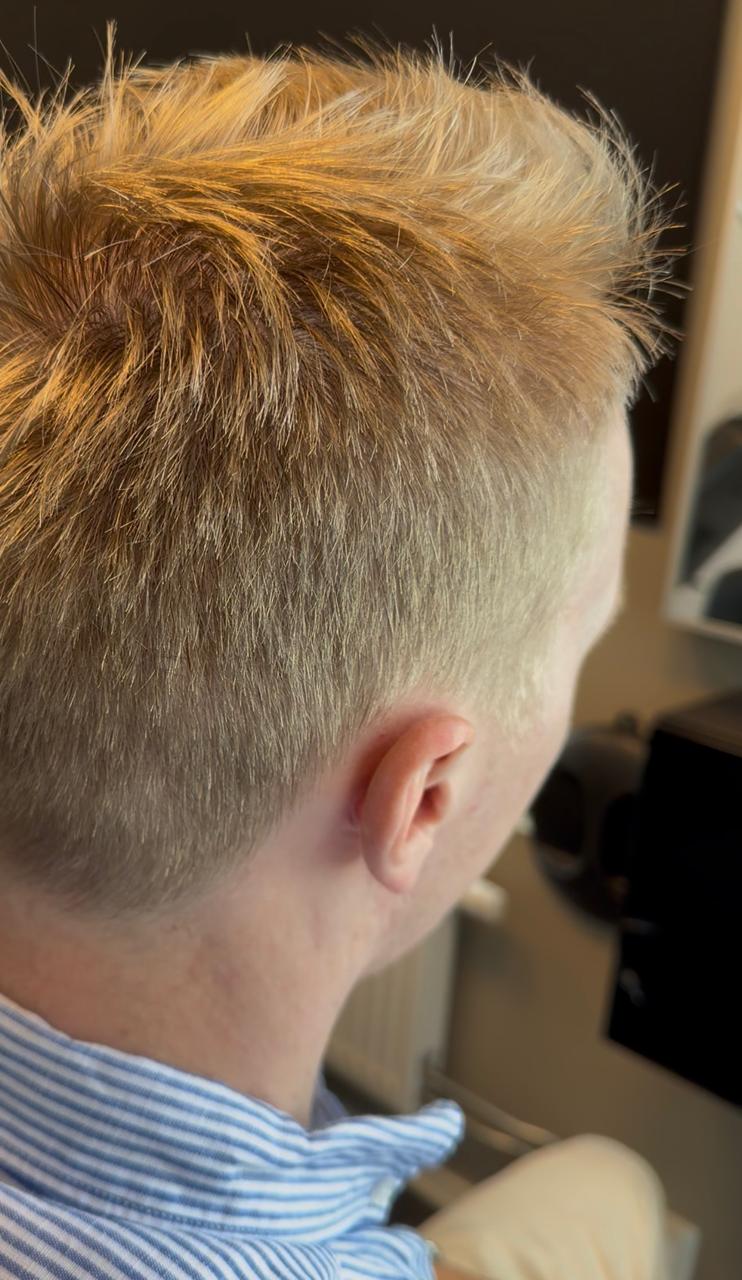 Donorområde efter hårtransplantation där längre hår ger visuell täckning