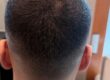 FUE ärr efter hårtransplantation behandlat med SMP