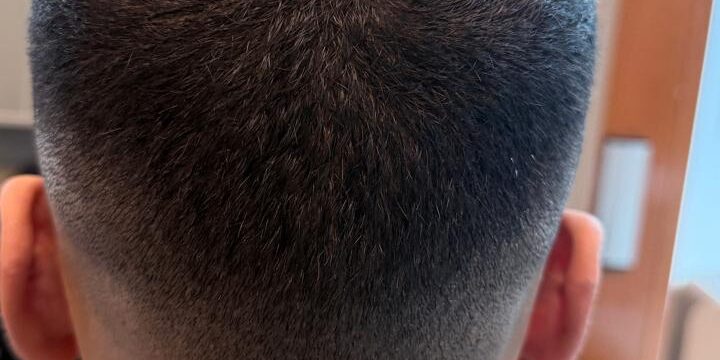 smp-fue-arr-kamouflering-efter-04 FUE ärr efter hårtransplantation behandlat med SMP