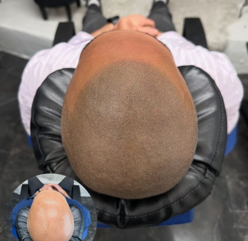 Hårpigmentering Priser